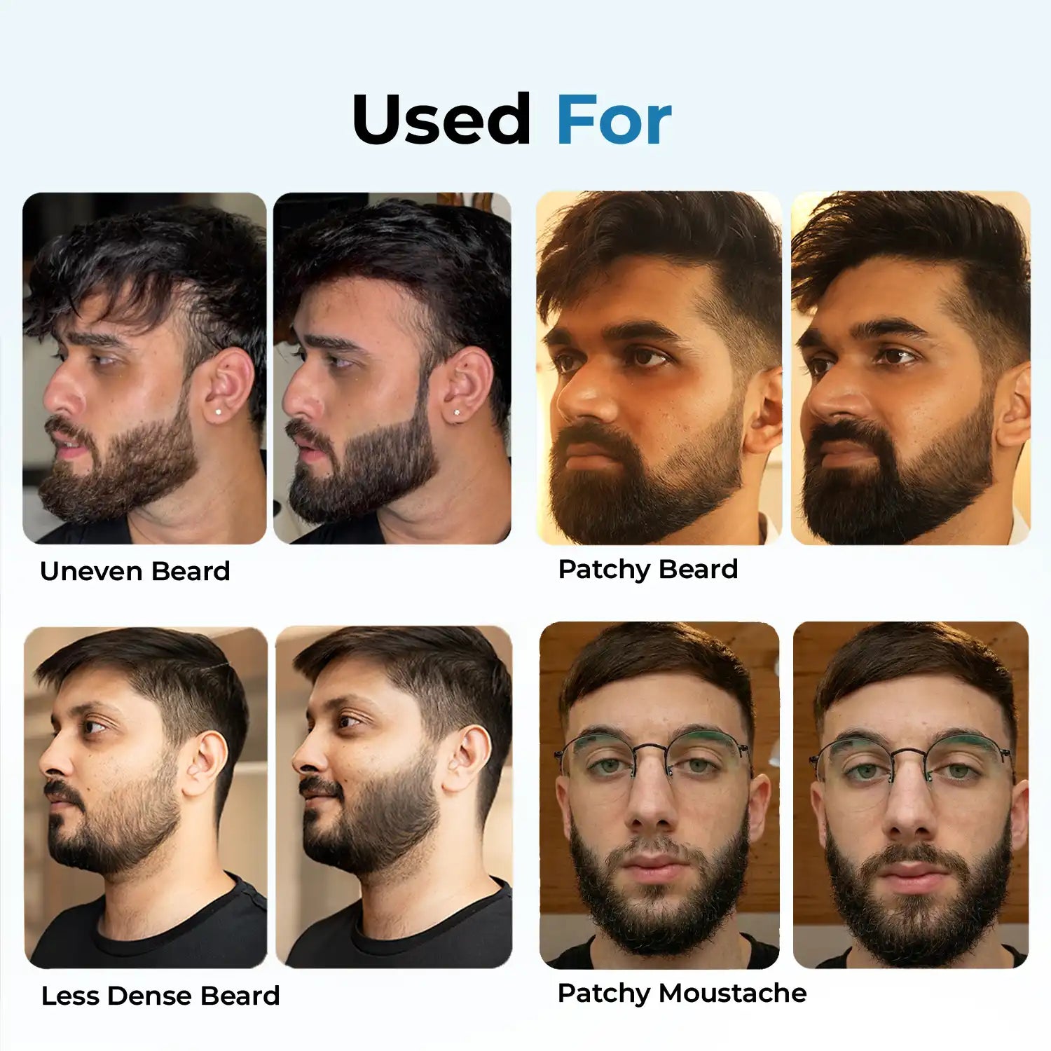 Patchy Beard Fix