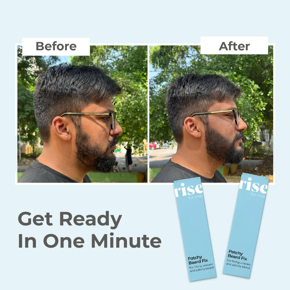 Patchy Beard Fix